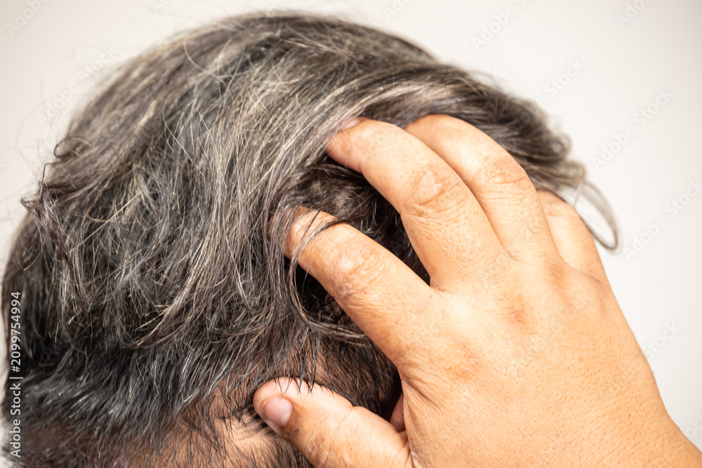 Fototapeta premium A middle-aged man is scratching his head, which is covered in gray hair, possibly due to itchy scalp, dandruff, or hair loss. Concepts related to health and skin disease treatment.