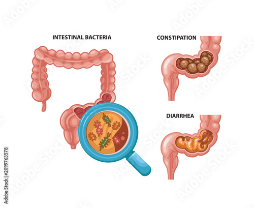 Intestinal Bacteria, Constipation and Diarrhea Comparison Illustration