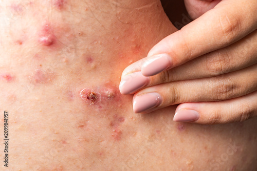 Foto Acne pimple with visible redness