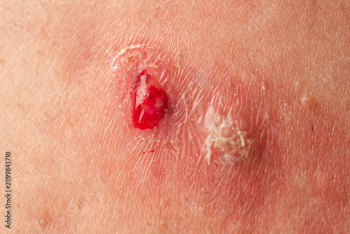 Foto Drainage from ruptured boil