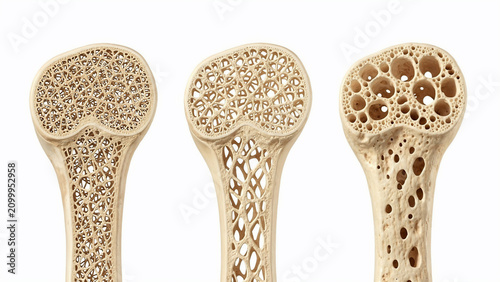 Cross-section of healthy and osteoporotic bone tissue, detailed 3D render showing trabecular bone structure, concept for medical education, bone health awareness and osteoporosis research