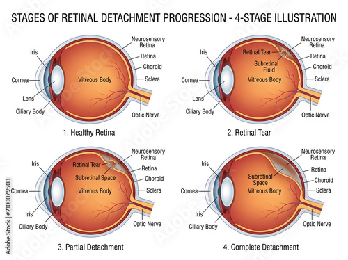 Stages of retinal detachment in human eye illustration isolated on white background
