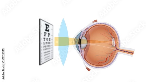 2D Hyperopia Correction Animation Farsightedness Vision Defect, Convex Lens Refraction, Human Eye Anatomy Diagram, Ophthalmology and Optometry Educational Medical Motion Graphic