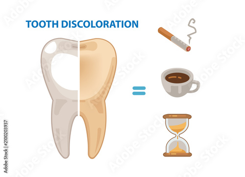 Tooth Discoloration Causes Educational Illustration