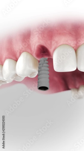 3D visualization of a dental implant: a two-piece screw-retained crown where the abutment is connected and then the screw connects the crown to the abutment.