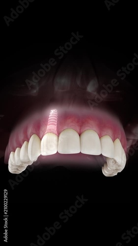 3D visualization of a dental implant of a maxillary lateral incisor with a transparent crown and visible gum anatomy on a black background.