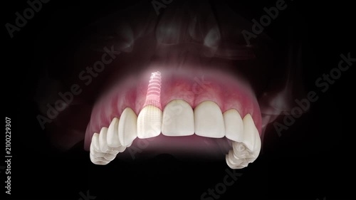 3D visualization of a dental implant of a maxillary lateral incisor with a transparent crown and visible gum anatomy on a black background.