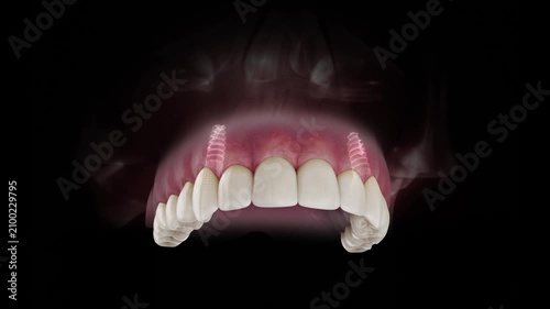 3D visualization of a dental implant of a maxillary both canines with a transparent crown and visible gum anatomy on a black background.