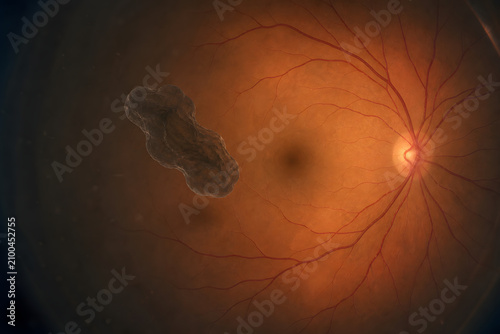 Vitreous floater drifting near macula inside human eye