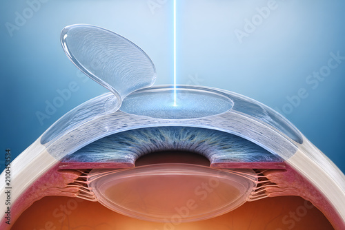 Laser vision correction corneal flap procedure illustration