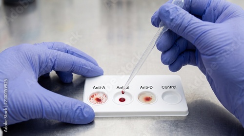 Laboratory Technician Performing a Blood Type Analysis Test on a Diagnostic Testing Card Using a Pipette for Medical Screening