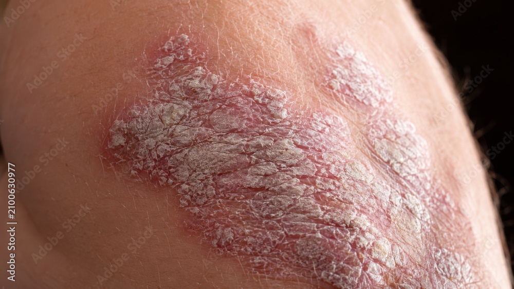 Fototapeta premium Macro of silvery flaky psoriasis plaques on a knee