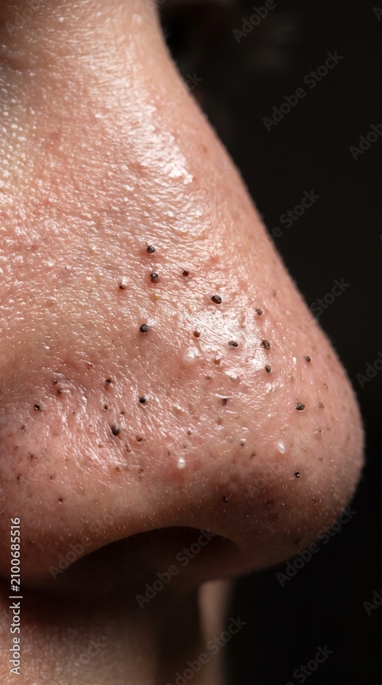 Naklejka premium Blackhead Comedones Nose Surface, Extreme Macro Close Up of Enlarged Skin Pores, Oxidized Sebum Plugs, Dermatological Skin Texture, Acne Prone Oily Skin Detail