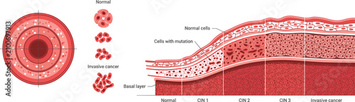 Konstfotografi Medical Illustration of Cervical Cell Changes from Normal to Invasive Cancer Key