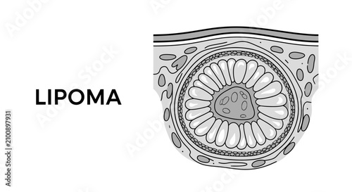 Foto Medical illustration of a lipoma, showing the cross-section of a fatty tumor beneath the skin layers