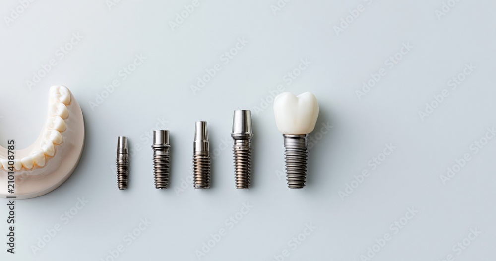 Fototapeta premium Dental implant components with tooth model