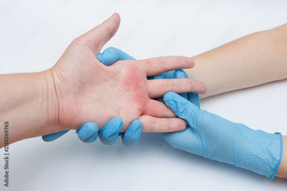 Fototapeta premium Medical examination of a patient's hand affected by skin inflammation or dermatitis, close-up, doctor wearing blue nitrile gloves.