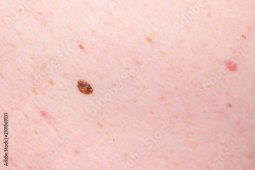 Foto Close-up view of light skin with multiple moles, freckles and skin imperfections