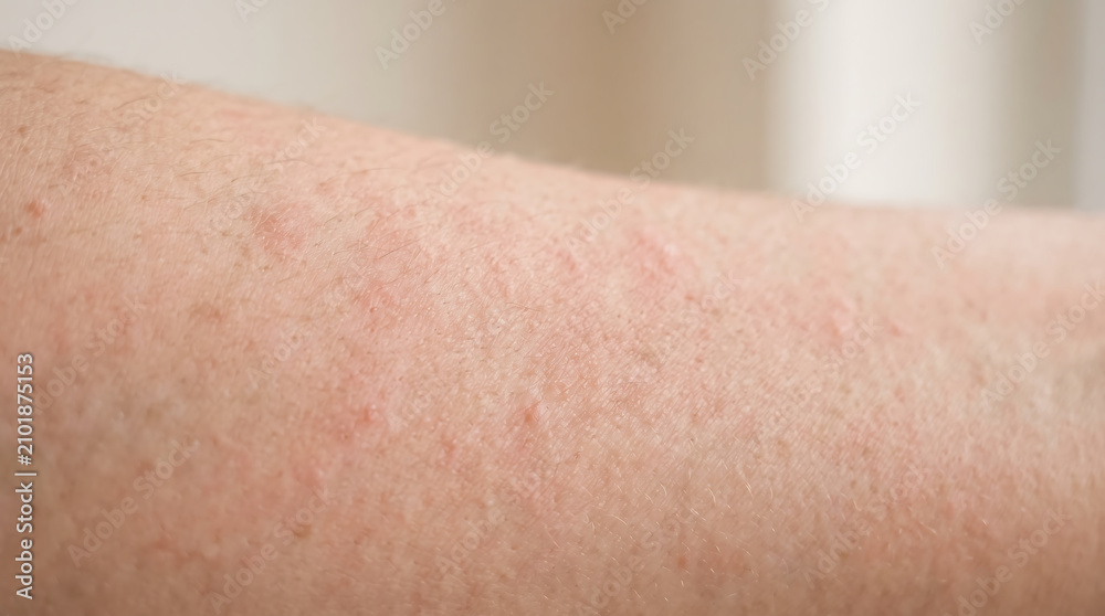 Fototapeta premium Close-up of red spots and mild rash on human skin, showing irritation, allergy, dermatitis, eczema, heat rash, or sensitive skin in a medical health concept.