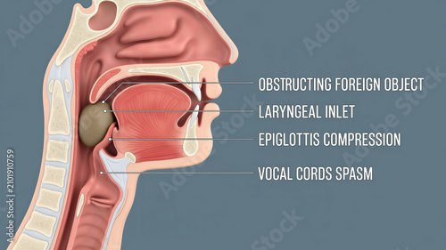 Anatomical cross section showing how a foreign object causes airway obstruction within the human throat and laryngeal area