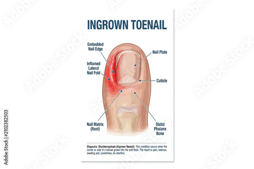Medical illustration showing inflamed ingrown toenail penetrating soft tissue.