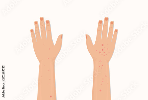Human arm with red skin rash, irritation and small bumps.