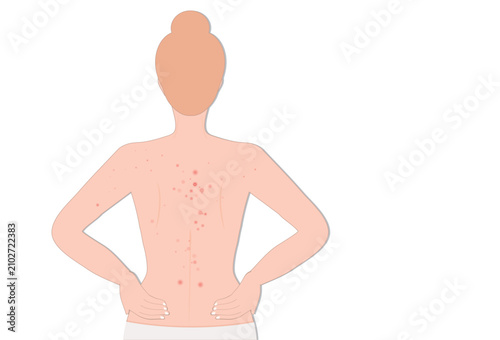 Woman s Back Covered with Red Skin Rash, Irritation and Small Bumps.