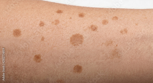 Tableau sur toile Multiple scattered discrete flat macules on human skin - Macule Plate (71-90)