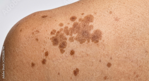 фотографія Confluent Macules on Human Skin  - Macule Plate (75-90)