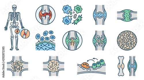 Konstfotografi Medical illustration of human skeletal system and joint conditions