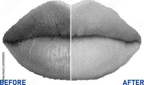 Canvas Print Before After Lip Enhancement Comparison Halftone Vector Illustration for Cosmeti