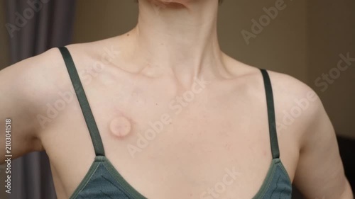 cancer survivor with a visible chest port and copy space, showing real patient experience, recovery, confidence and life after chemotherapy