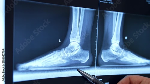 Male hand holding a pen pointing at the MRI scan of feet. Close up. Digital medical monitor displaying lateral X-ray views of human feet and ankles.