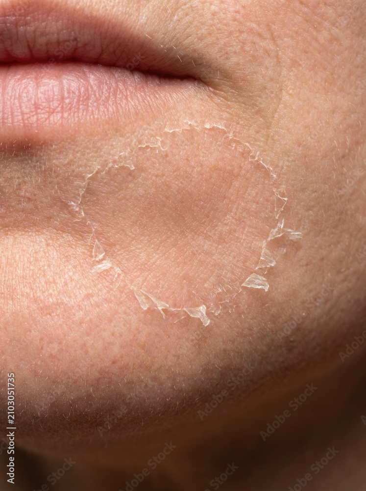 Fototapeta premium Dry skin texture macro close up reveals peeling skin around mouth area, showcasing skin health