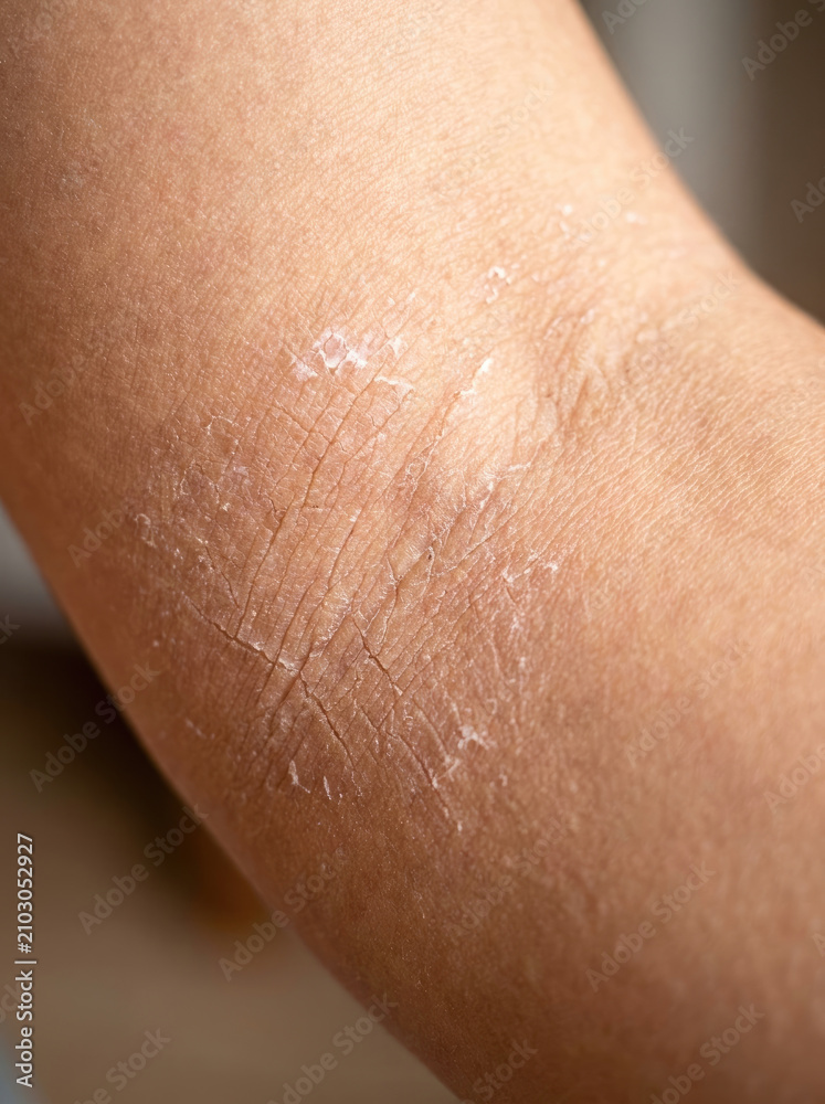 Fototapeta premium Dry skin with visible cracks and peeling on arm, highlighting skin barrier issues