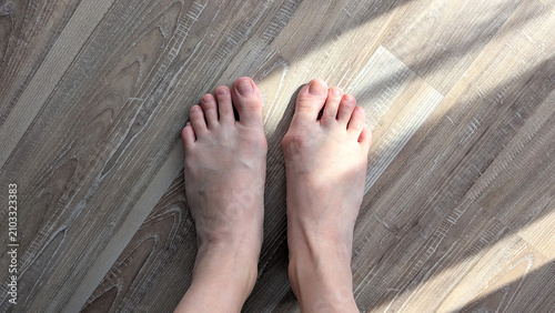 Top Down View of Bare Human Feet on Wooden Floor Showing Hallux Valgus Bunion Deformity on Right Foot