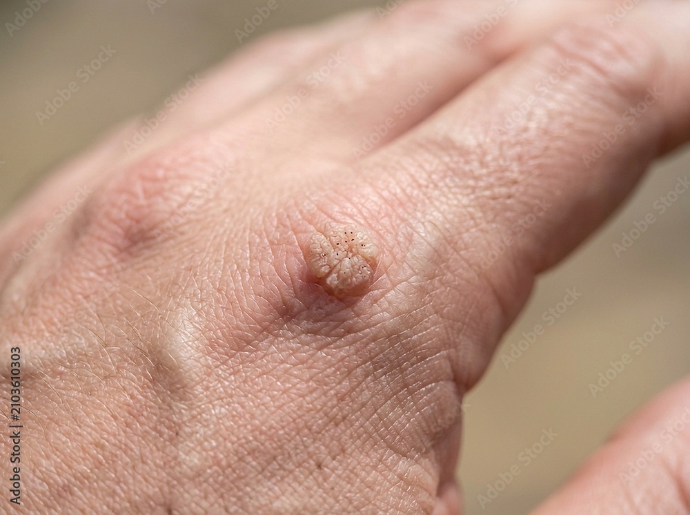 Fototapeta premium A textured common wart growing on the skin of a human hand