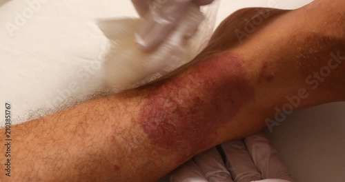 Close-up shot of a medical professional wearing latex gloves treating a patient's leg. The patient has a severe, large red skin lesion, which could be the result of a severe allergic reaction