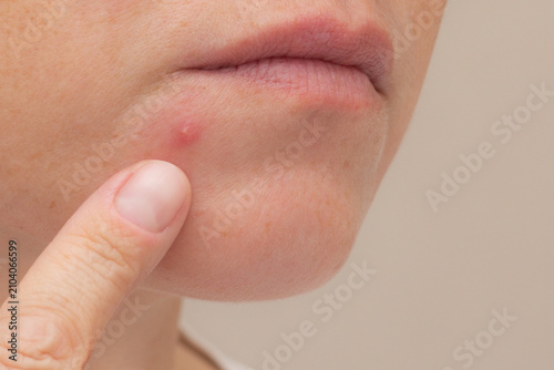 Canvastavla Inflamed Pimple Near the Lower Lip