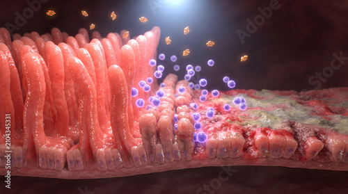 Medical 3D illustration showing the comparison between healthy intestinal villi and damaged, inflamed villi affected by celiac disease or gluten enteropathy.