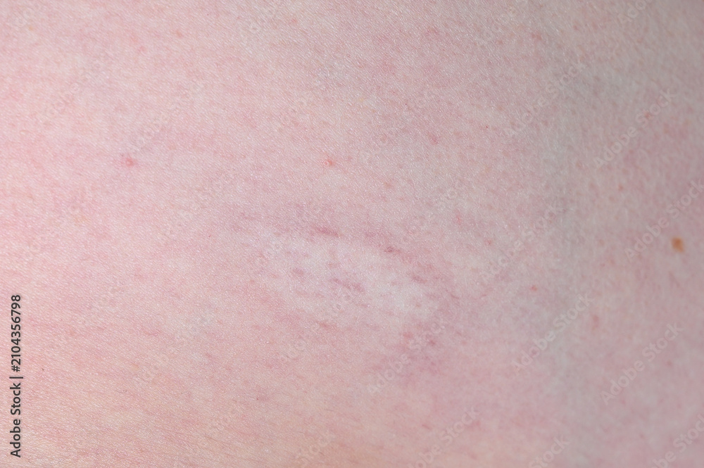 Fototapeta premium Close-up of fair skin showing visible capillaries, small red spots and fine skin texture