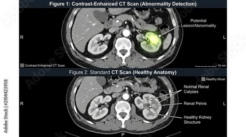 Medical CT scan comparison of healthy kidney anatomy and renal abnormality, contrast-enhanced computed tomography showing lesion detection