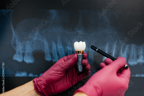 Dentist presenting dental implant and explaining treatment plan using panoramic dental X-ray, concept of implant dentistry, oral surgery and tooth replacement