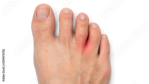 Morton neuroma in the forefoot with interdigital nerve pain between toes, photorealistic medical education image on a white clinical background for patient education and healthcare communication