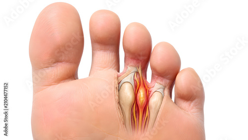 Morton neuroma in the forefoot with interdigital nerve pain between toes, photorealistic medical education image on a white clinical background for patient education and healthcare communication