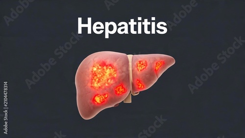 Hepatitis disease concept with inflamed human liver on dark grey background
