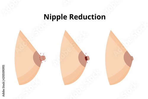Nipple reduction procedure stages diagram showing cosmetic surgery