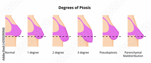 Degrees of breast ptosis classifying sagging levels