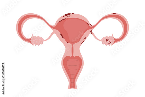 Endometriosis affecting uterus, fallopian tubes and ovaries