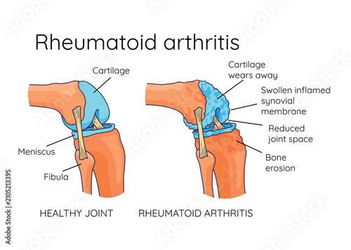Quadro su tela Rheumatoid arthritis